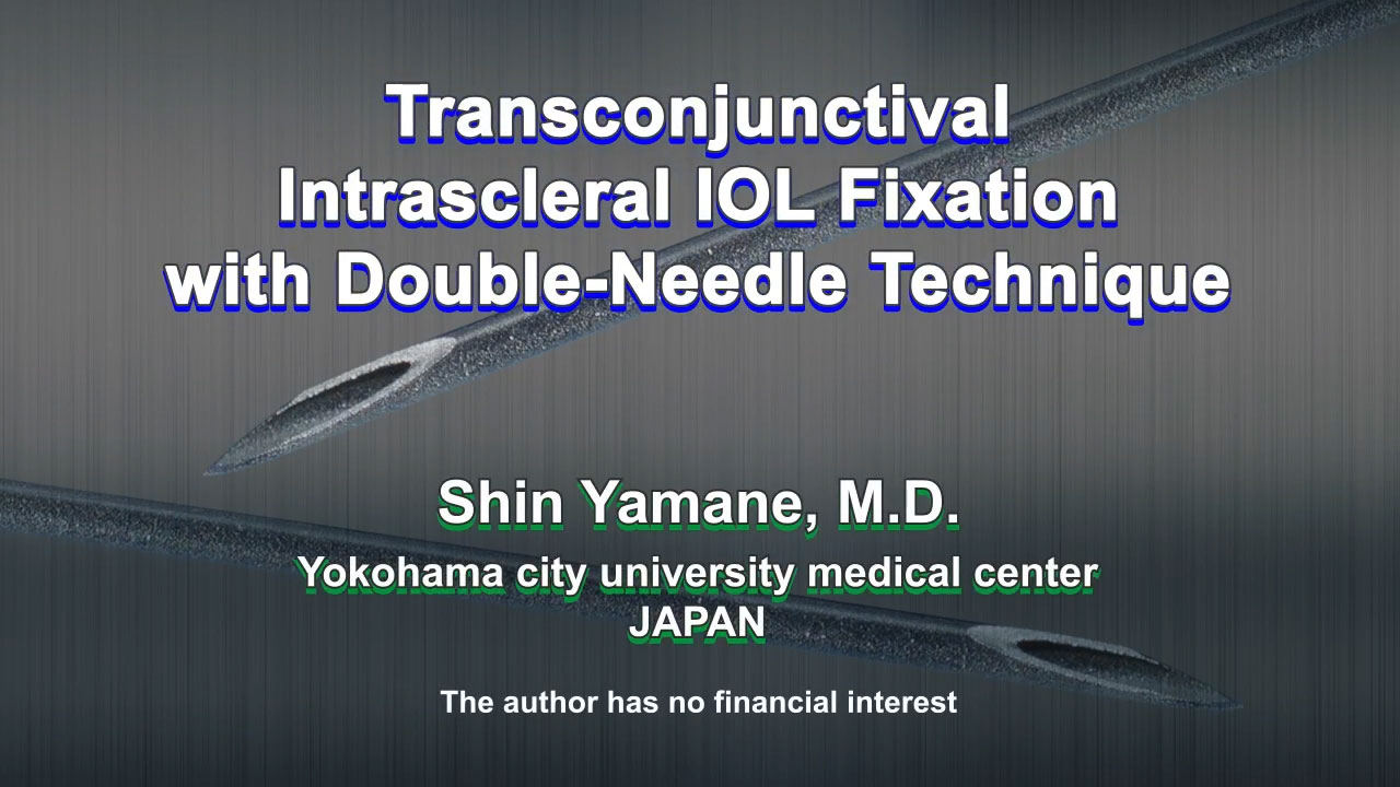 Transconjunctival Intrascleral IOL Fixation with Double-Needle Technique